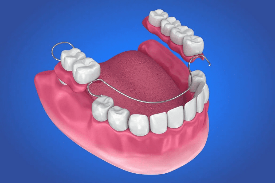 Partial dentures in Mithapur Patna