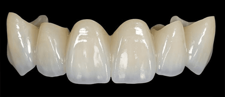 Cosmetic smile improvement