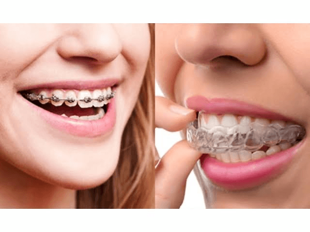 Orthodontic treatment in Mithapur Patna